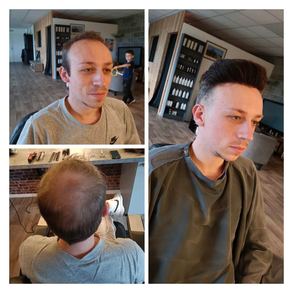 Traitement contre la chute de cheveux femme à Lille